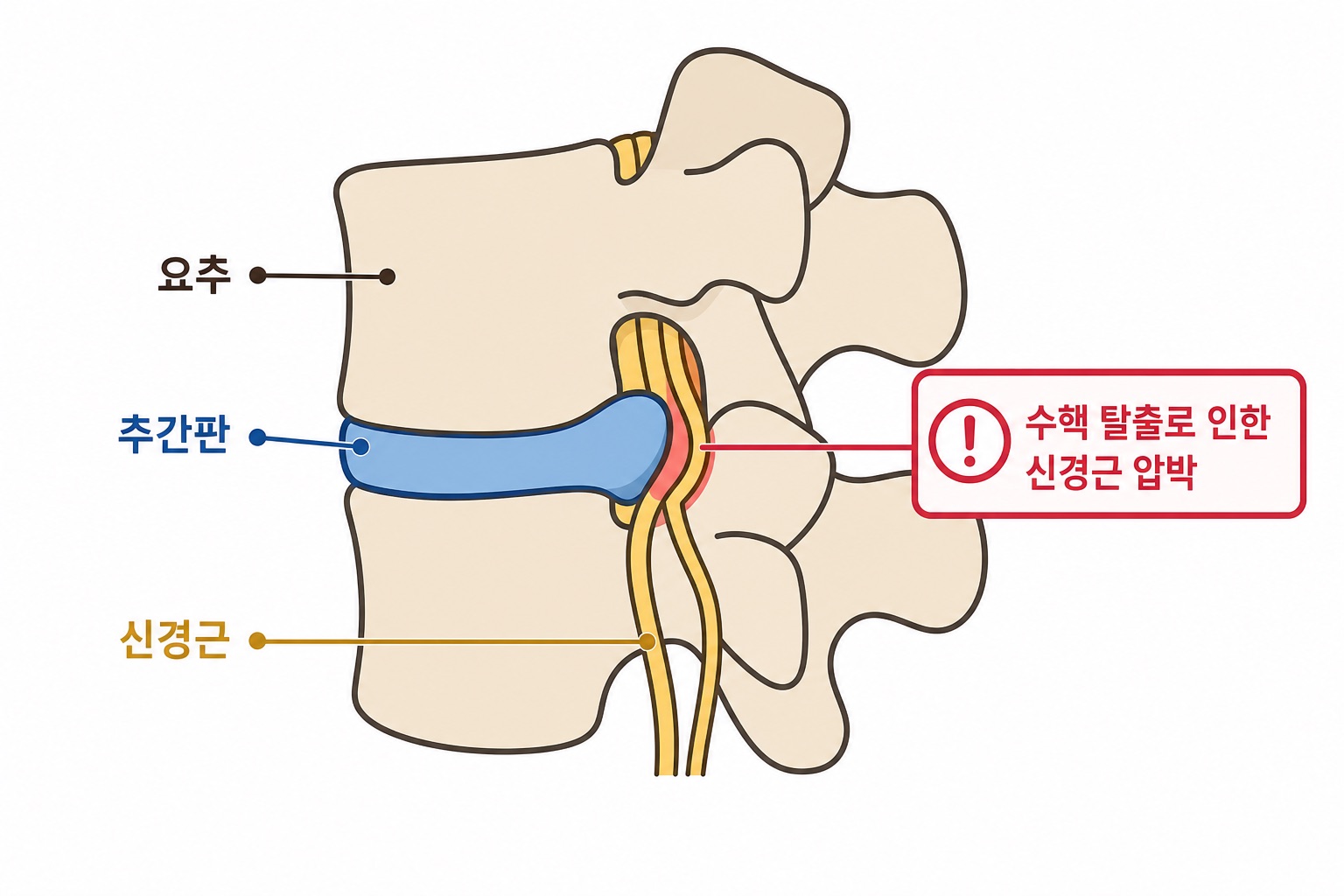 같은 자료로 만든 블로그 이미지 — 요추·추간판·신경근이 한글로 표기되고 수핵 탈출로 인한 신경근 압박 부위가 강조된 요추 측면 해부도